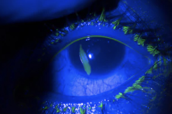 Corneal Abrasion