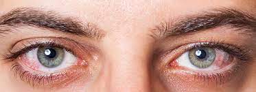 Dry Eye Syndrome