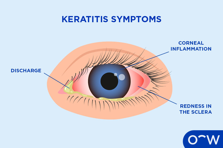 Keratitis 